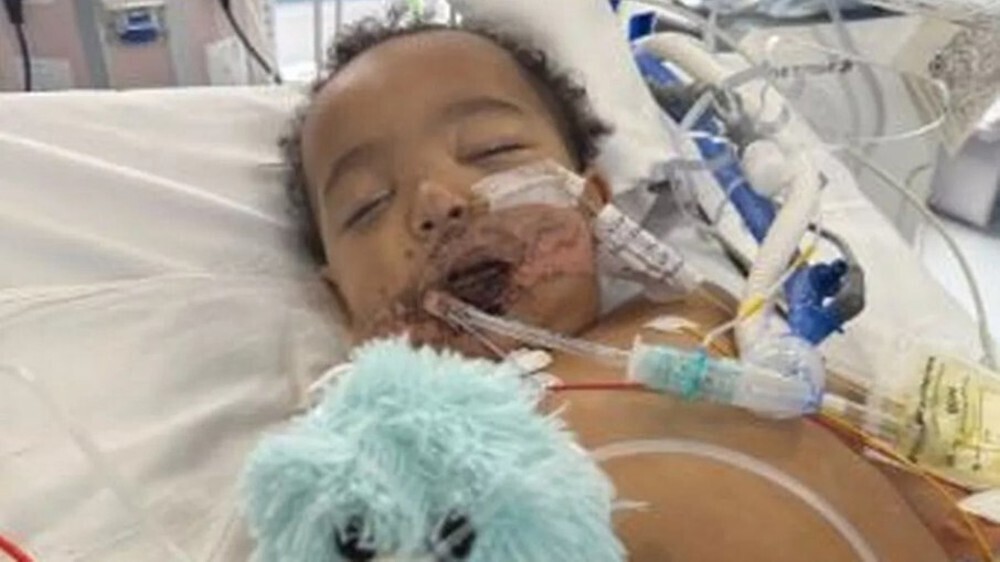 CUIDADO-Bebê de pouco mais de 1 ano perde a língua após confundir mamadeira com soda cáustica