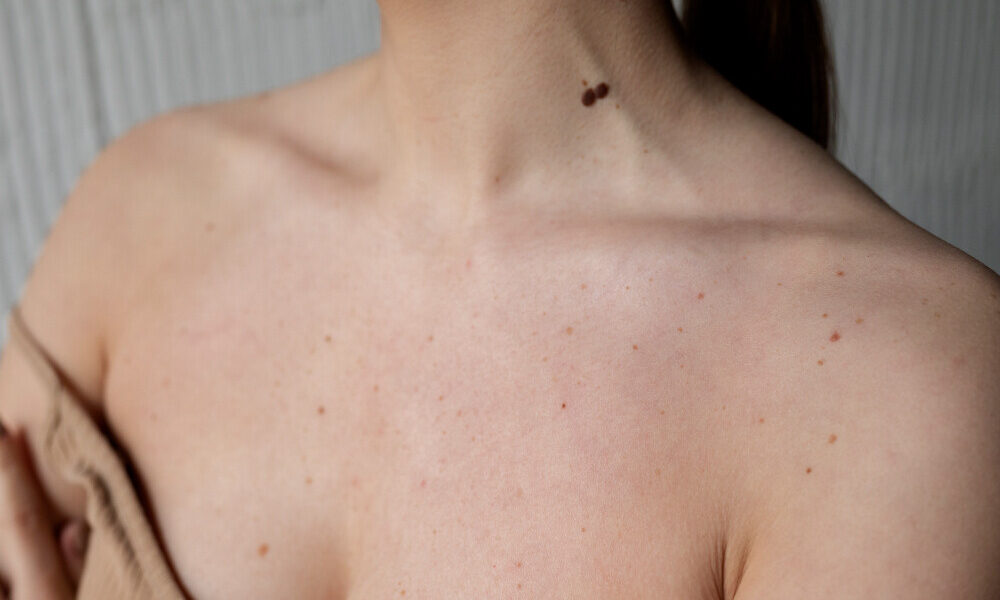 Manchas na pele afetam mais de um terço das mulheres brasileiras e o diagnóstico tardio piora o quadro